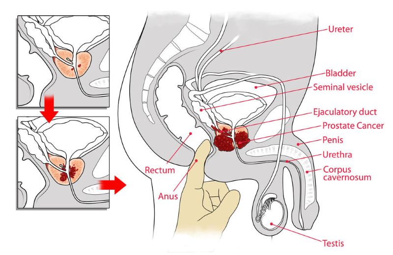 A Man's Guide to Prostate Health This September