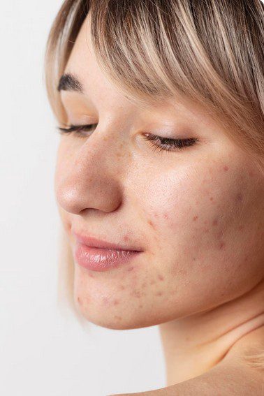 The Ultimate Guide: How to Create the Right Skincare Routine for Acne-Prone Skin