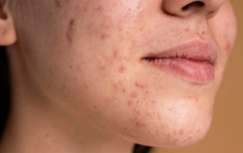 How to Create the Right Skincare Routine for Acne-Prone Skin