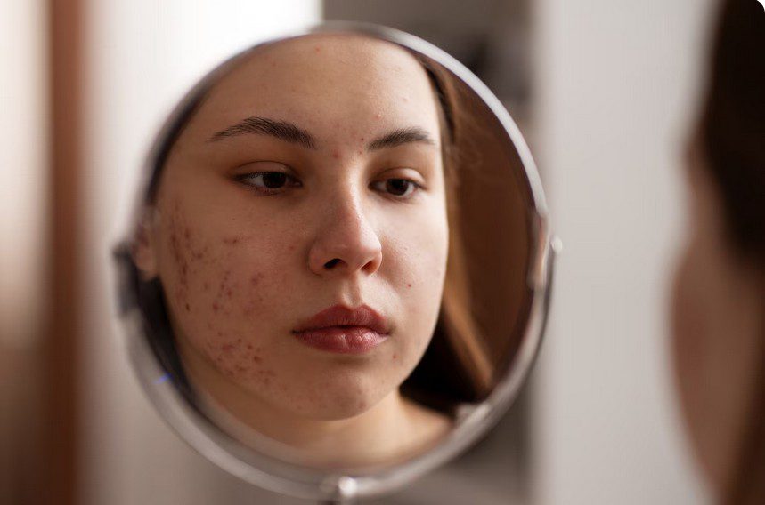 The Ultimate Guide: How to Create the Right Skincare Routine for Acne-Prone Skin