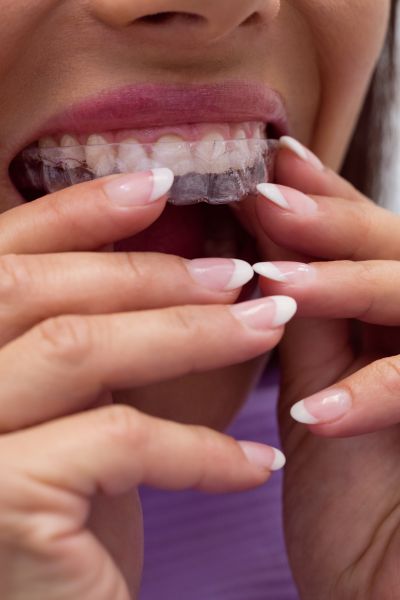 Why Are More Adults Choosing to Straighten Their Teeth?