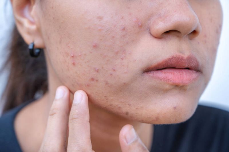 stock-photo-close-young-asian-woman-worry-her-face-she-has-problems How to Create the Right Skincare Routine for Acne-Prone Skin