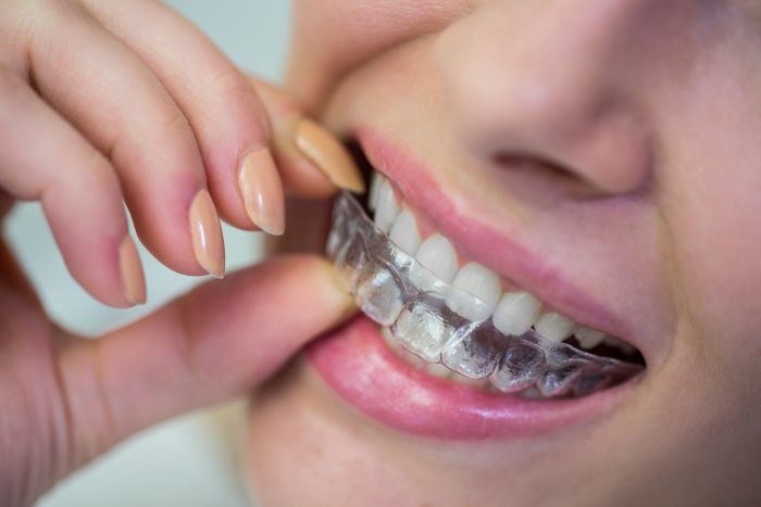 Why Are More Adults Choosing to Straighten Their Teeth?
