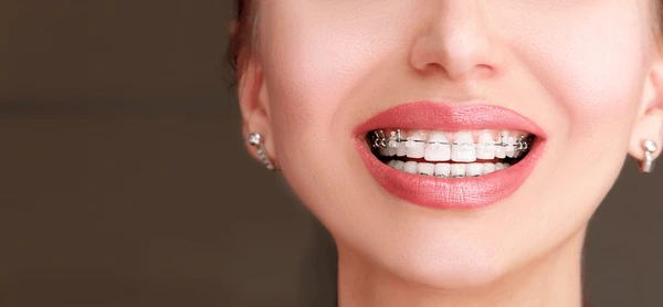 Invisalign vs. Damon Braces: Which is Right for Your Smile?