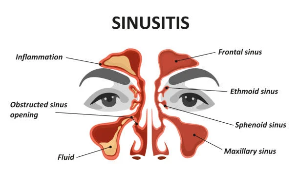 Beyond the Sniffles: Understanding and Managing Chronic Sinusitis