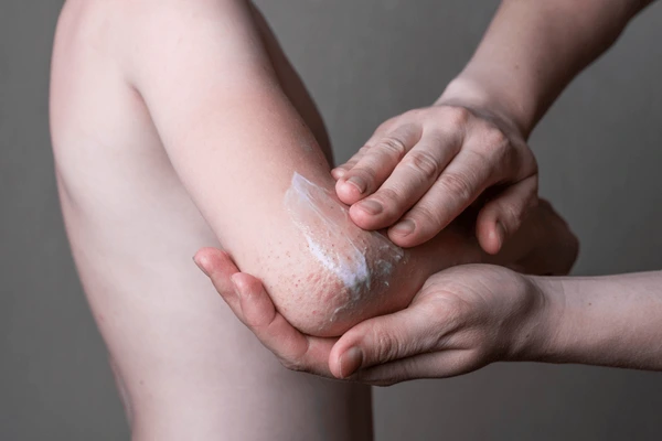 How To Manage Your Child's Eczema In The Winter
