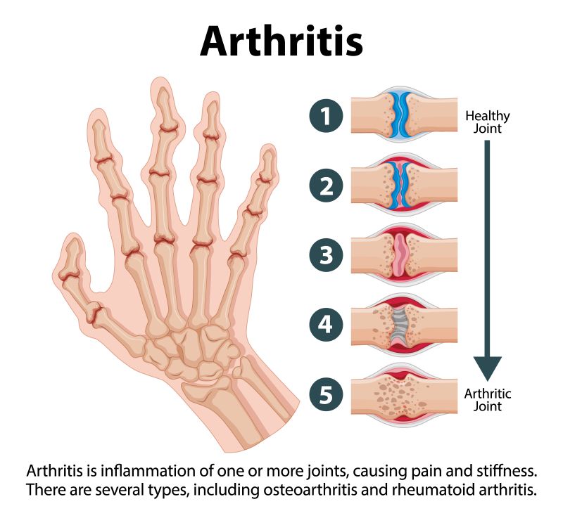 Why Joint Pain & Arthritis Worsen in Winter