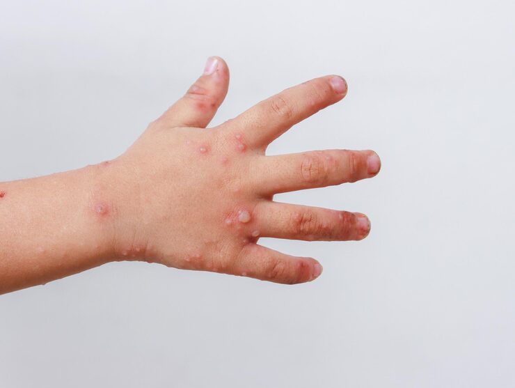 Unusual Surge in Hand, Foot, and Mouth Disease