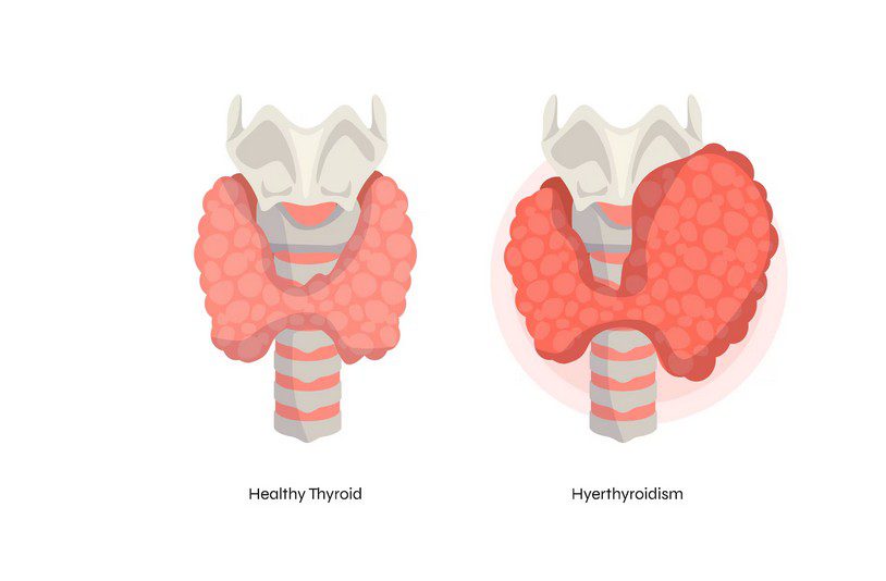 What Causes Hypothyroidism in Women? What Causes Hypothyroidism in Women?
