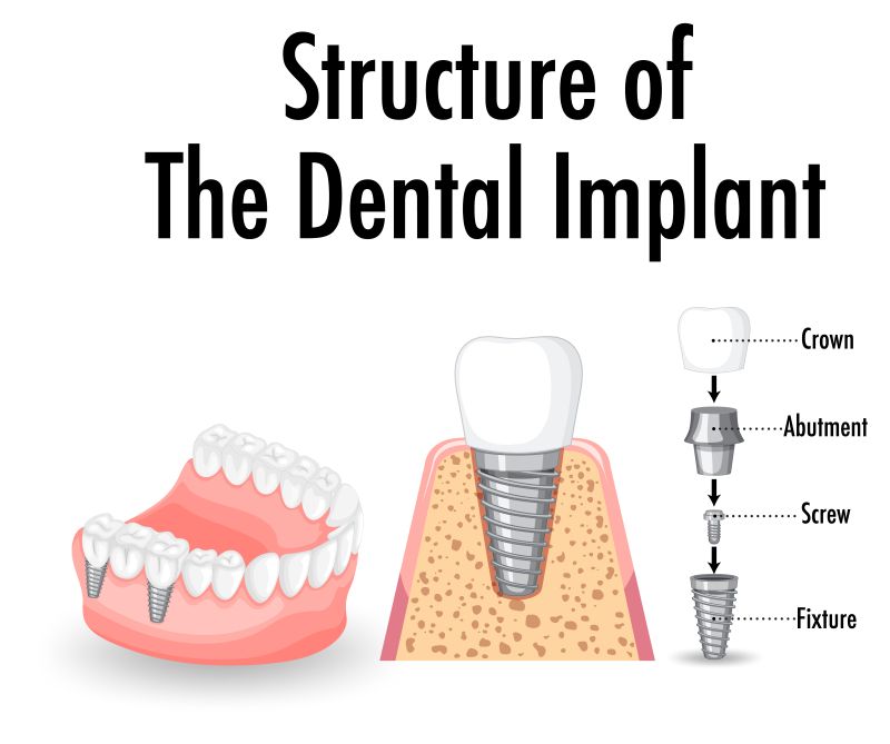Do You Need Dental Implants? Here's How to Know