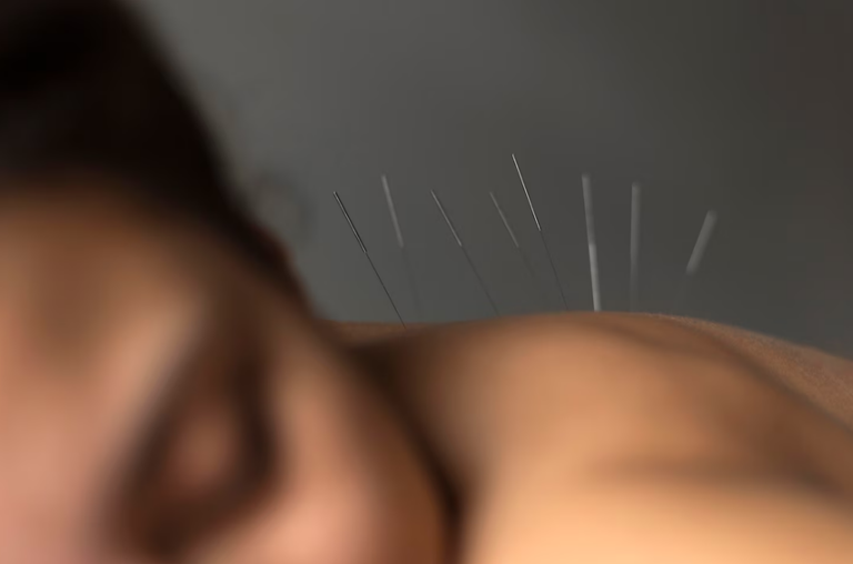 Acupuncture