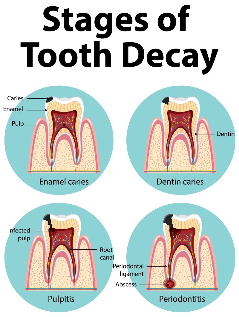 Cavities Infographic of human in the stages of tooth decay