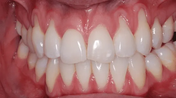 Receding Gums Receding Gums