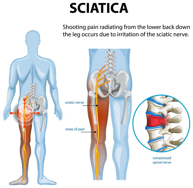 Sciatica Sciatica