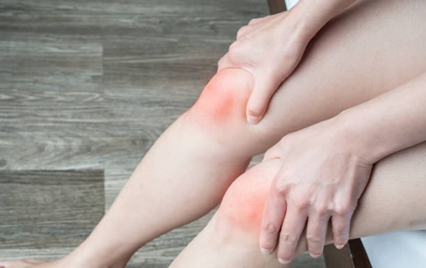 Soft Tissue Sprain Soft Tissue Sprain