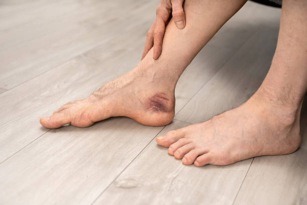 Soft Tissue Sprain Soft Tissue Sprain