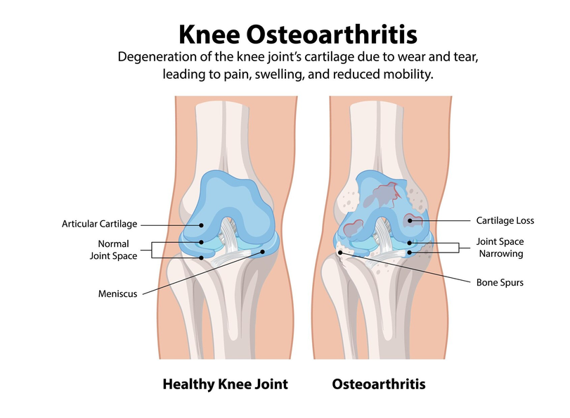 Knee Osteoarthritis Knee Osteoarthritis