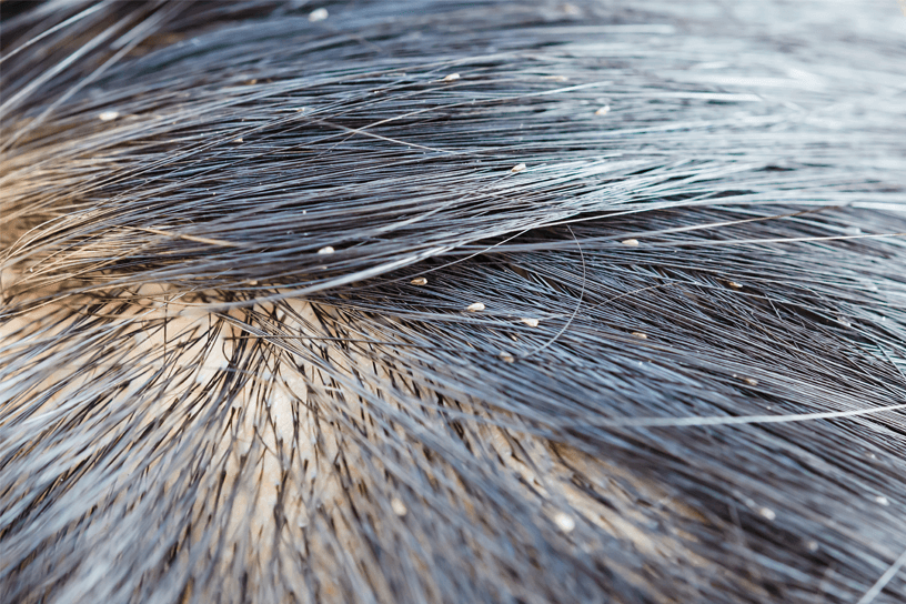 What Do Head Lice Look Like? What Do Head Lice Look Like?