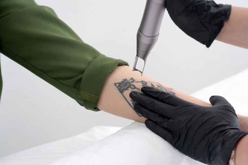How Many Laser Tattoo Tattoo Removal: Costs, Treatments, Risks and What to Expect